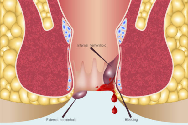 How to Choose best Piles Surgery in Surat: A Guide to Effective Treatment Options